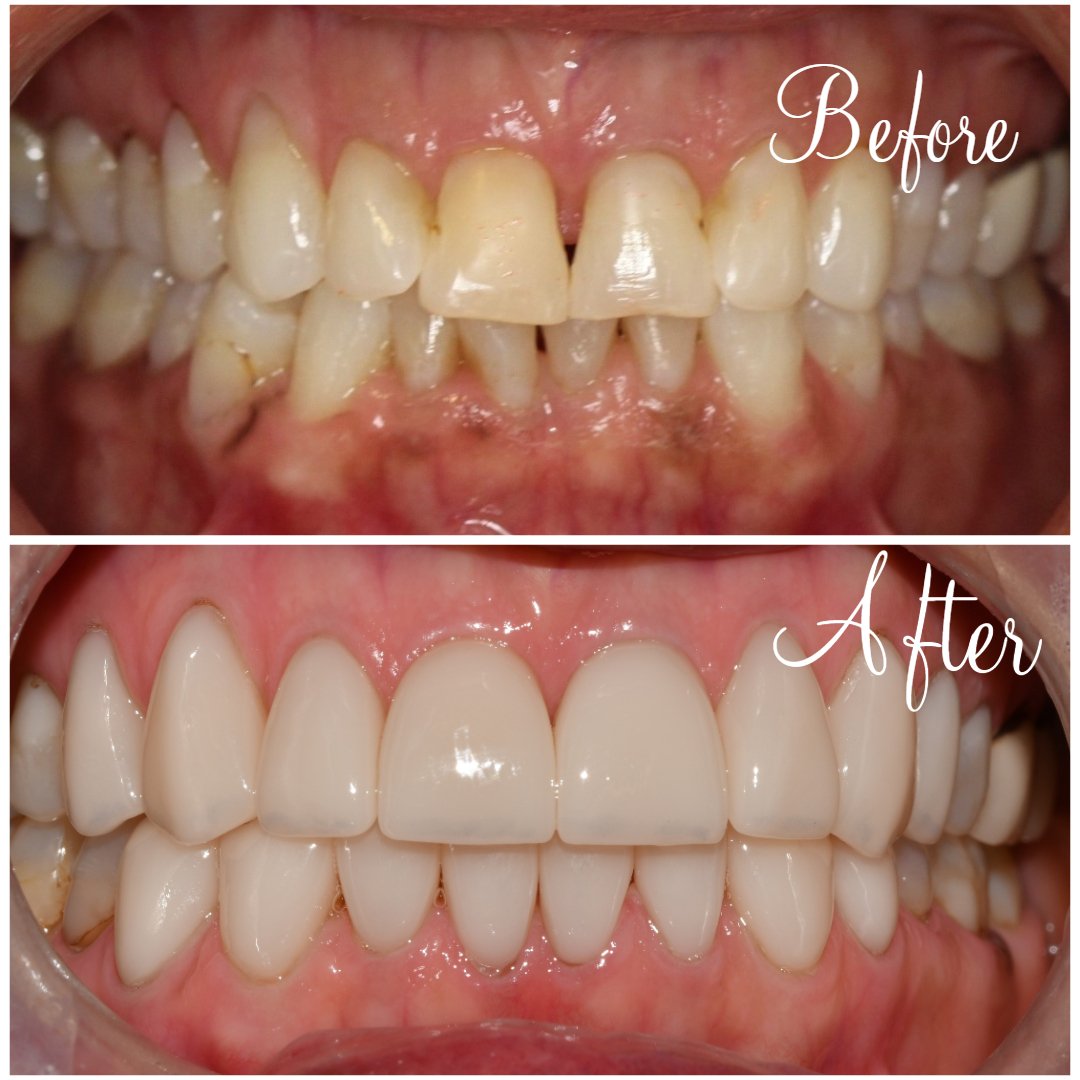 Dental bonding vs Veneers Veneers 2