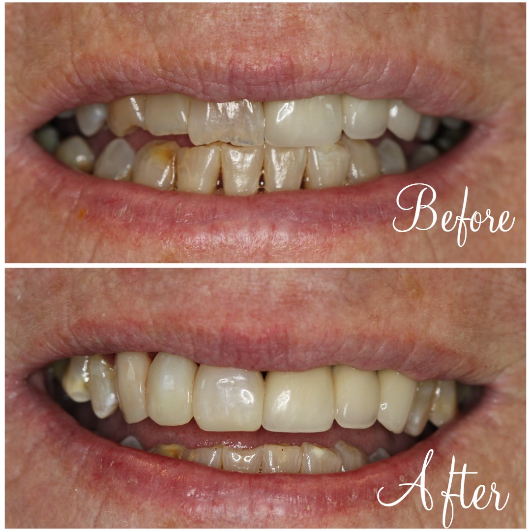 Dental bonding vs Veneers bond1