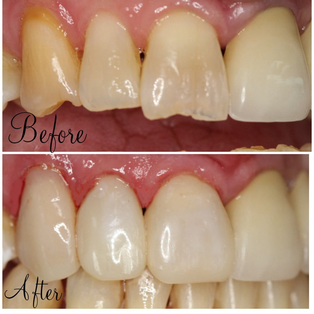 Dental bonding vs Veneers bond2