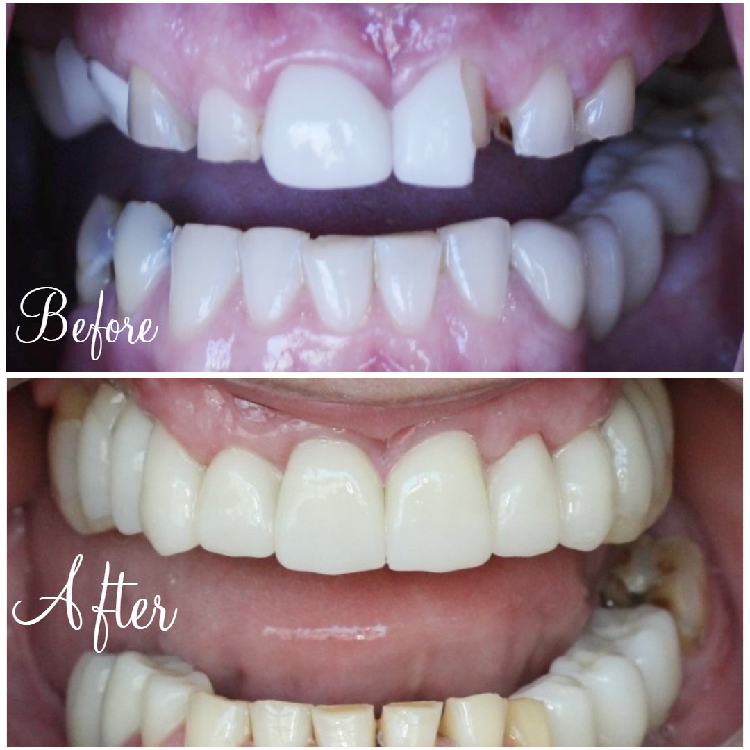 Full Mouth Rehabilitation Full Mouth 1