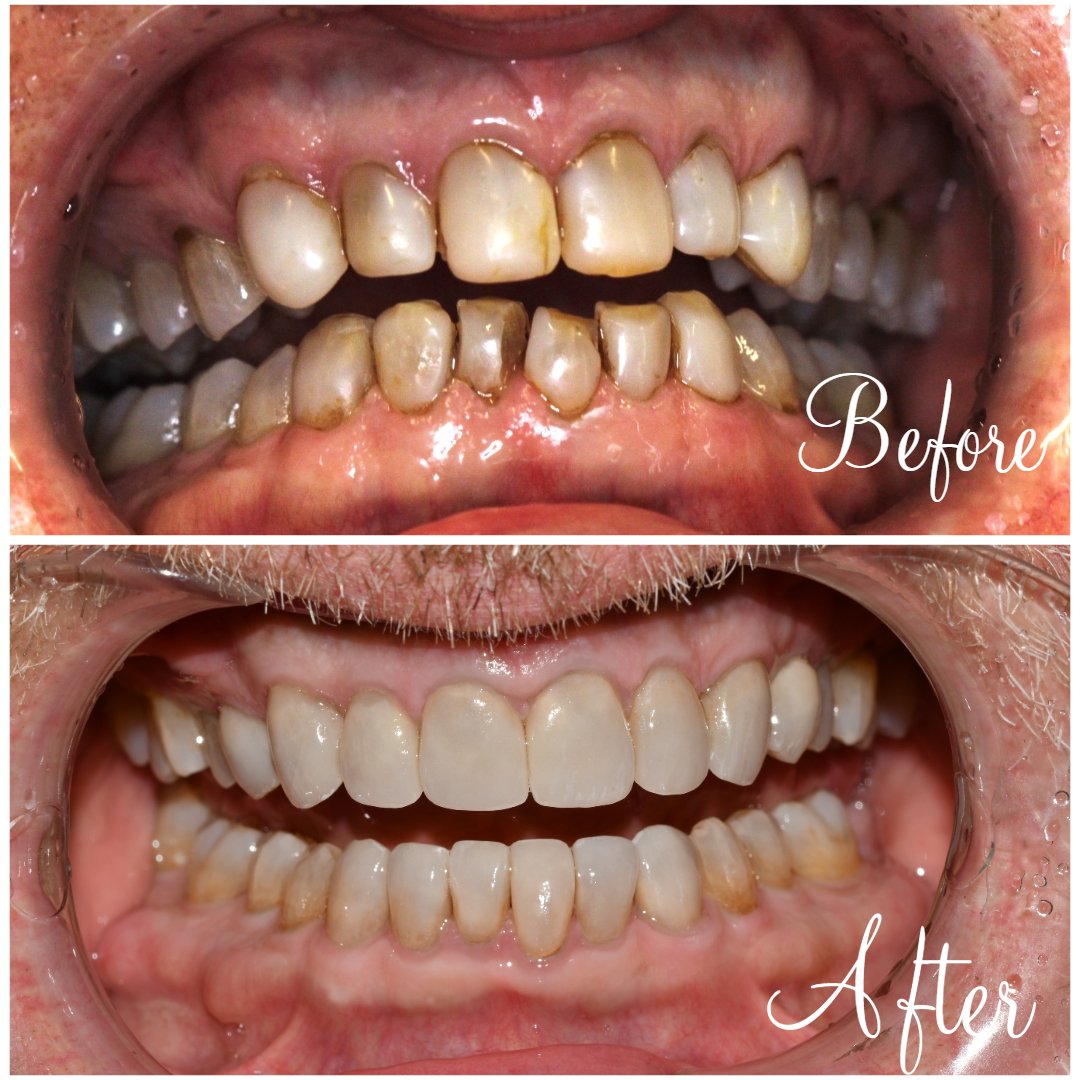 Full Mouth Rehabilitation Full Mouth Crowns and Veneers 1
