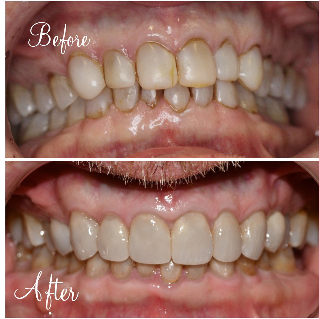Full Mouth Rehabilitation Full Mouth Crowns and Veneers