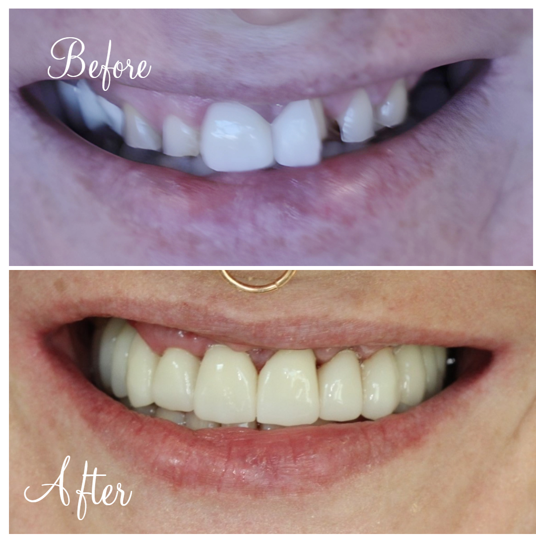Full Mouth Rehabilitation Full Mouth