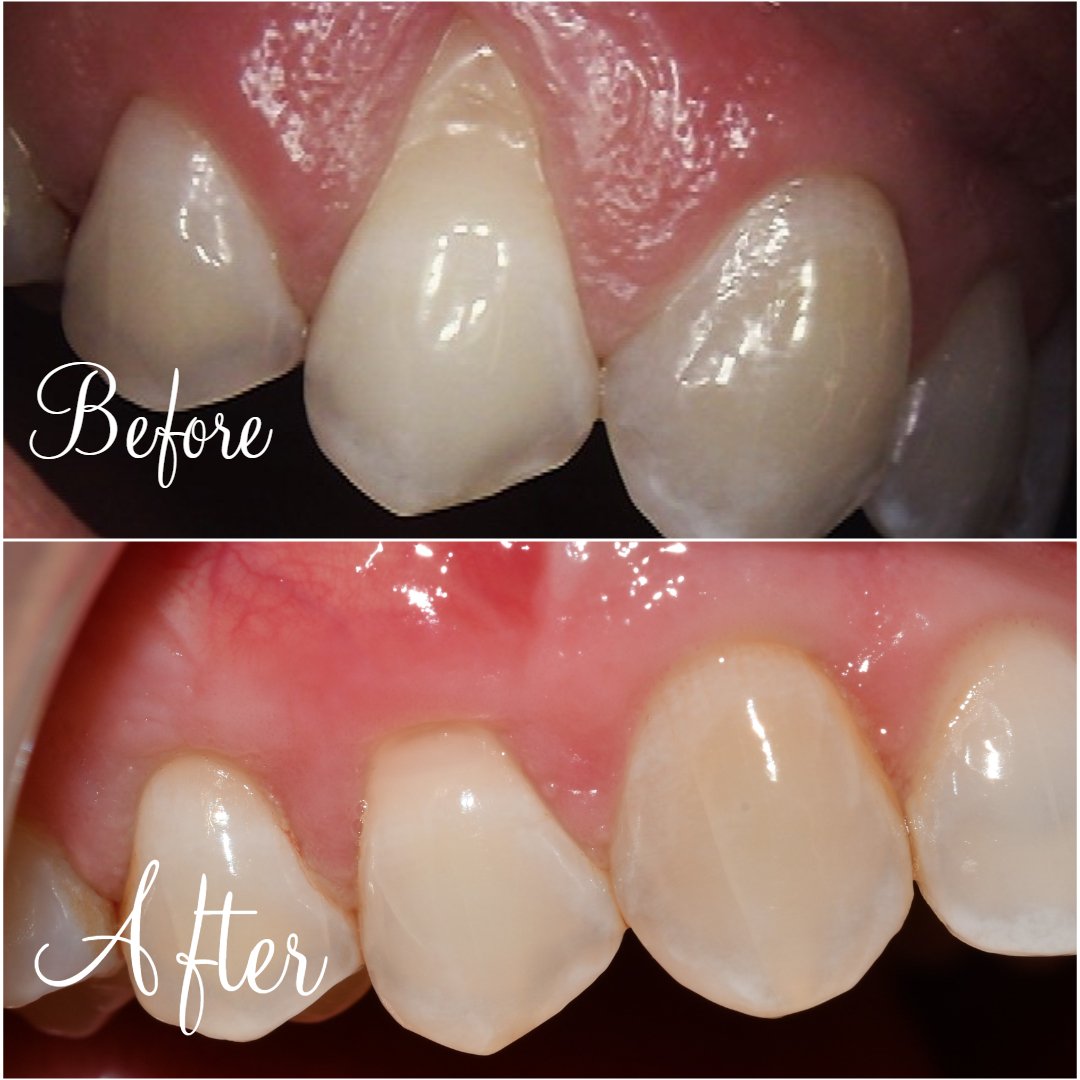 Gum Grafting 1 site before and after
