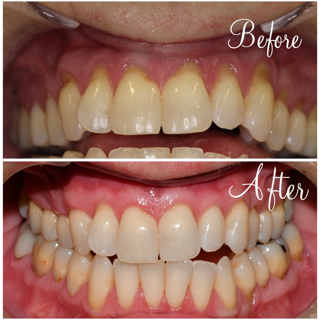 Gum Grafting advanced before and after