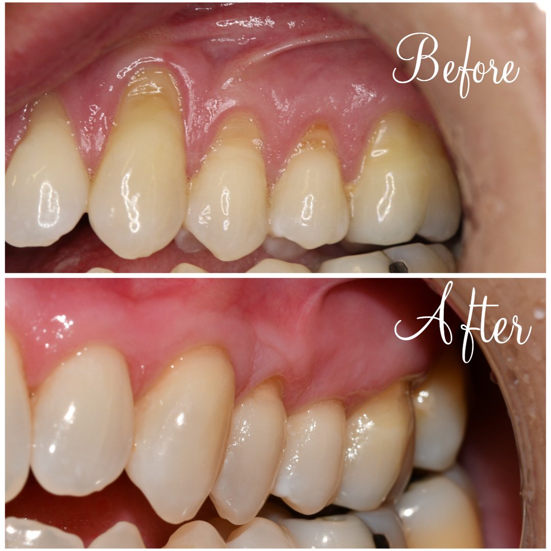 Gum Grafting quadrant before and after